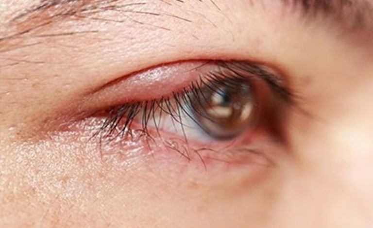 All You Need To Know About Blepharitis Spanish Eye Center 