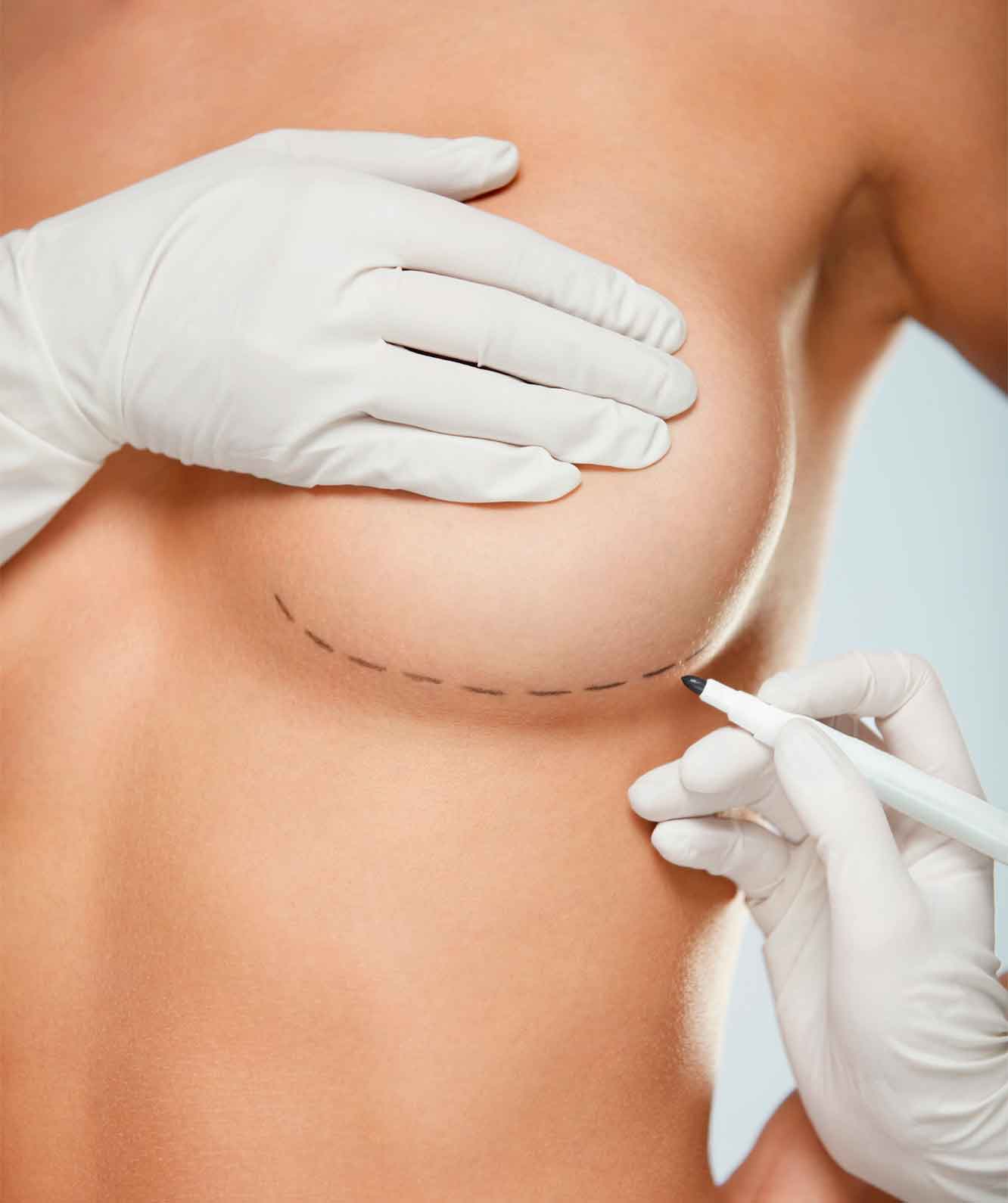 Breast surgeries